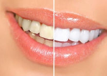 Load image into Gallery viewer, Bright White Smiles - 35% Teeth Whitening Kit - Tooth Gel Whitener and Trays Included - Made in The USA - Ships from Oral Care Dental Laboratory