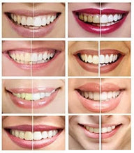 Load image into Gallery viewer, 10 Syringes (3ml) New Strongest 44% Carbamide Peroxide Teeth whitening Gel (Mouth Trays NOT Included)